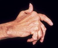 Facts about Arthritis