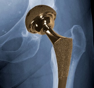 Metal Hip Implant