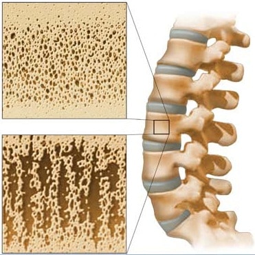 Osteoporotic Bone