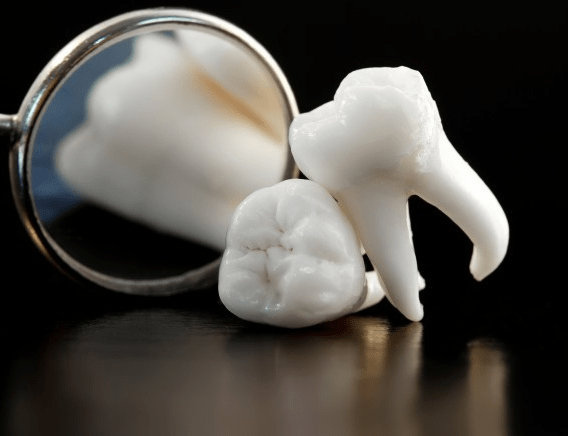Ailing Teeth needing Extraction