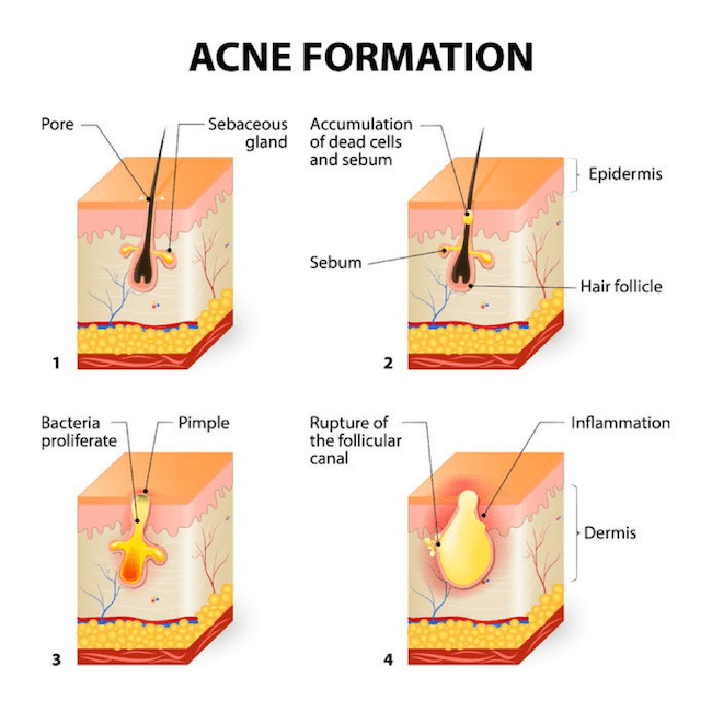 Acne Formation Diagram