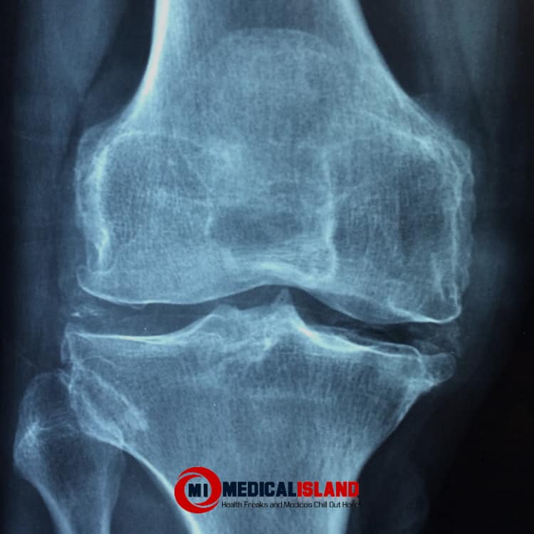 Arthritis Knee Joint