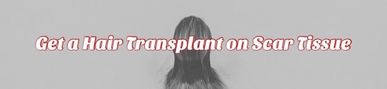 Hair Transplant on Scar Tissue