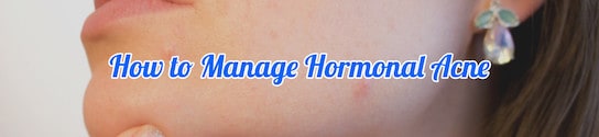 Manage Hormonal Acne Header