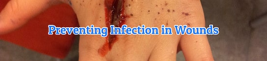 Preventing Infection in Wounds