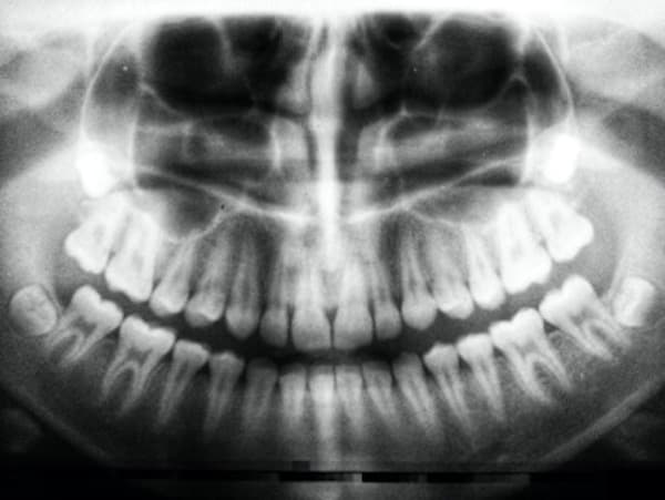 Intraoral X-Rays Blog Post