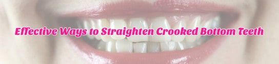 3 Effective Ways to Straighten Crooked Bottom Teeth