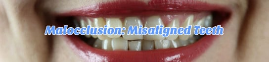 Malocclusion Misaligned Teeth Header