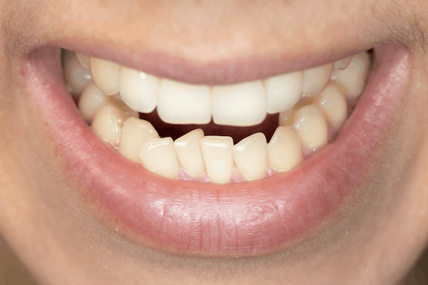 Malocclusion Misaligned Teeth