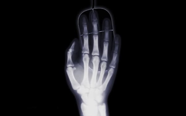 Hand Fracture X-Ray