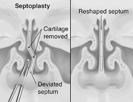 Septoplasty Before and After