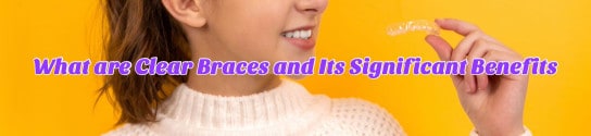 What are Clear Braces and Its Significant Benefits