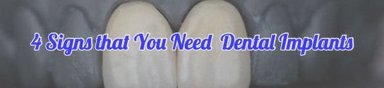 4 Signs That Indicate the Need for Dental Implants