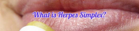 What is Herpes Simplex?
